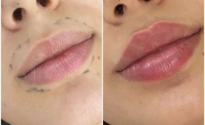 Juvederm Facial Rejuvenation Best Plastic Surgeon in dubai