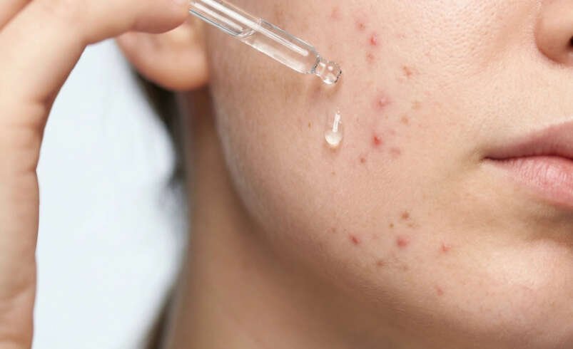 Acne Treatments in Melbourne, FL: A Complete Guide to Clearer, Healthier Skin