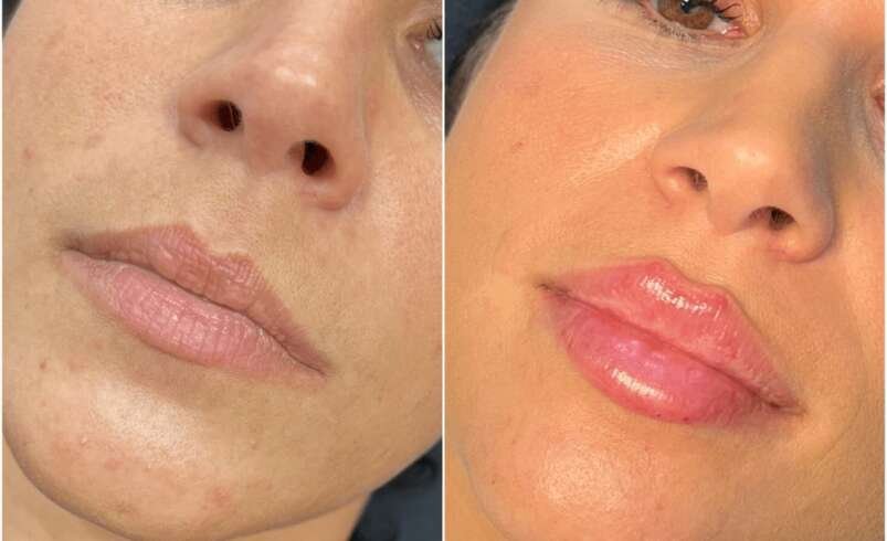 Juvederm Treatments in Dubai Cosmetic Confidence