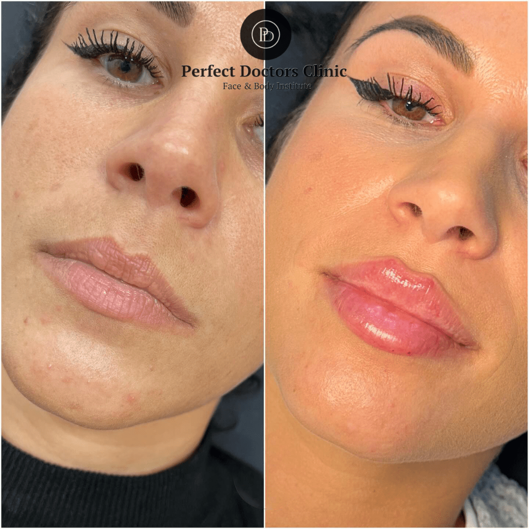 Juvederm Treatments in Dubai Cosmetic Confidence