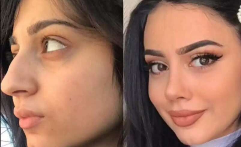 Why Trust the Best Doctors in Dubai for Advanced Rhinoplasty?