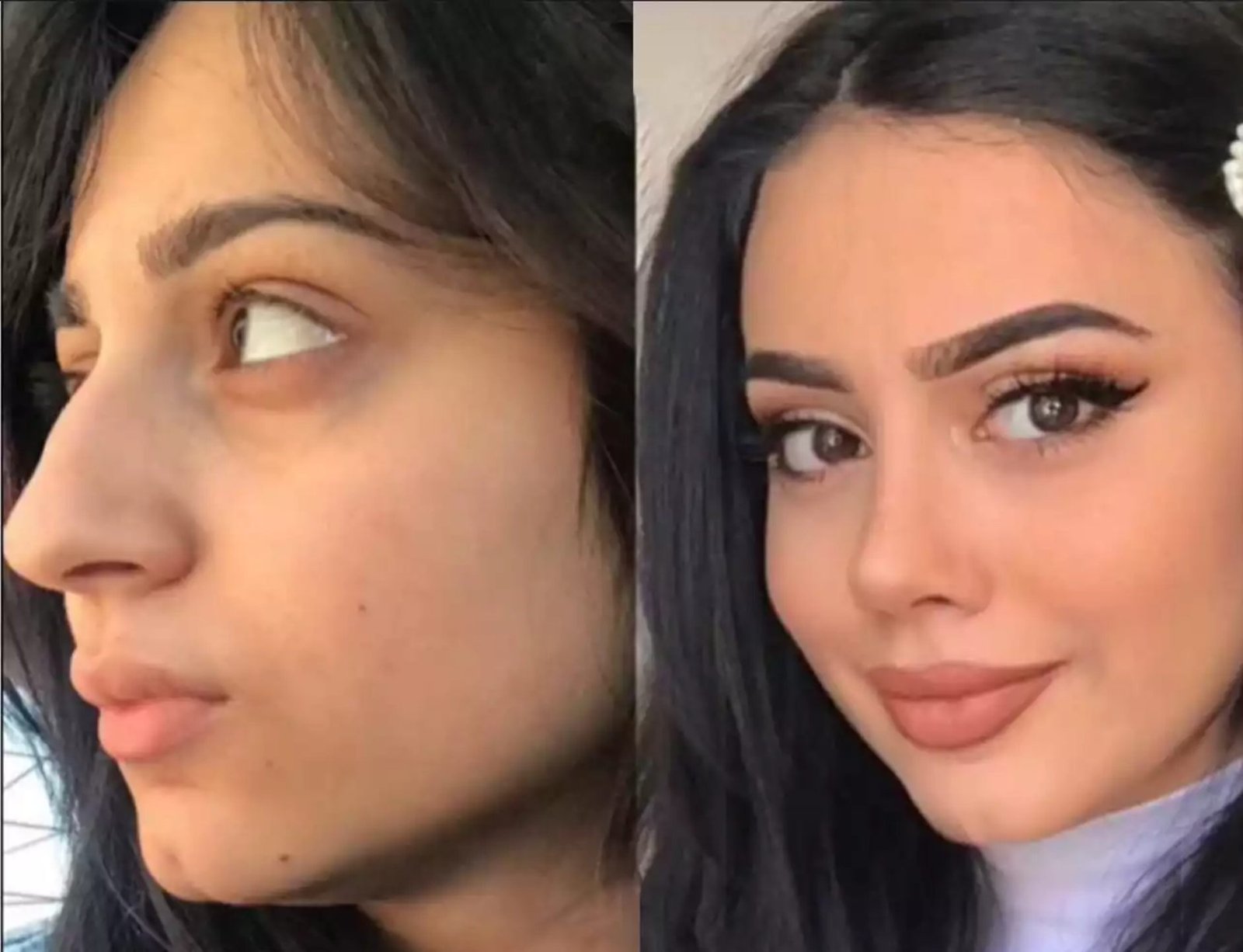 Why Trust the Best Doctors in Dubai for Advanced Rhinoplasty?