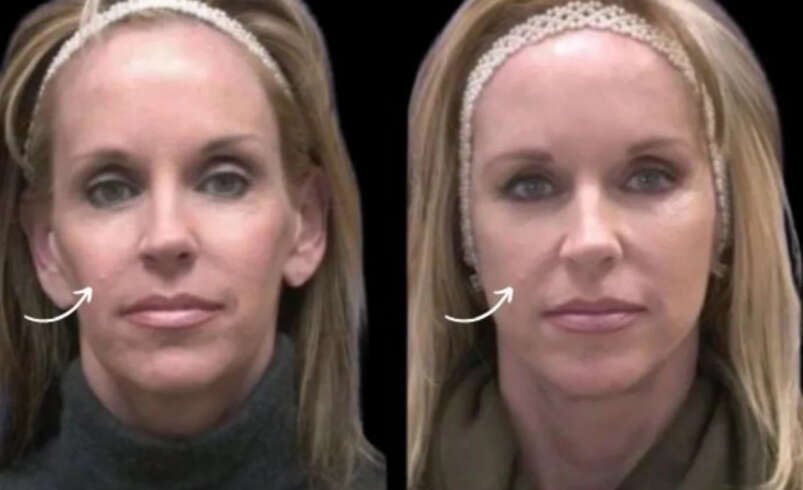 Sculptra Fillers Treatment in Dubai for Melanin Rich Skin