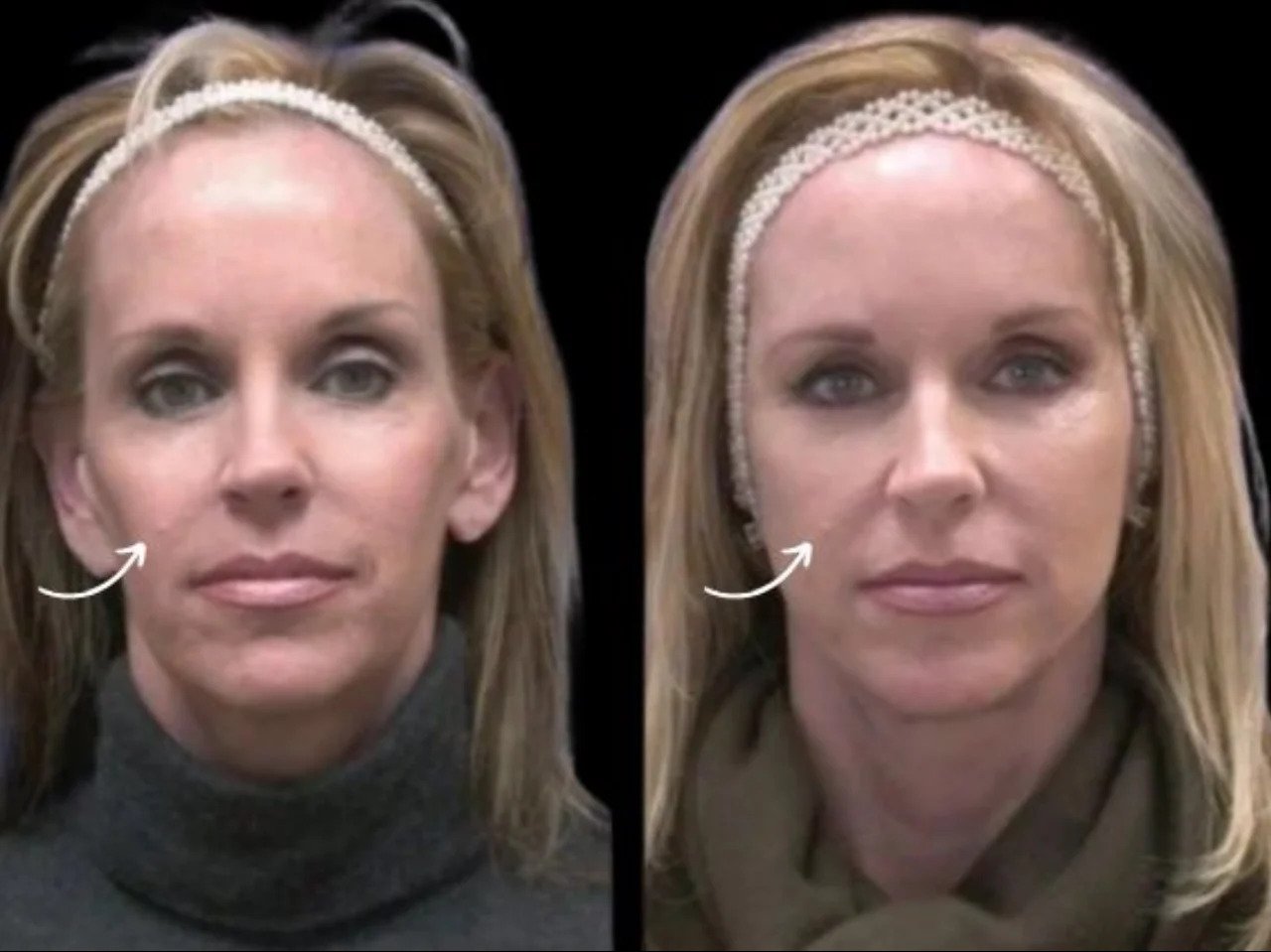Sculptra Fillers Treatment in Dubai for Melanin Rich Skin