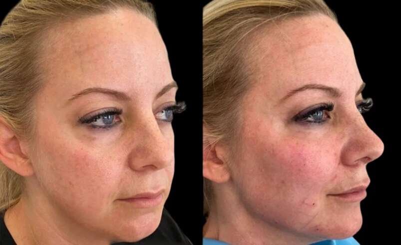 Cheek Fillers Recovery Tips from Best Doctors in Dubai