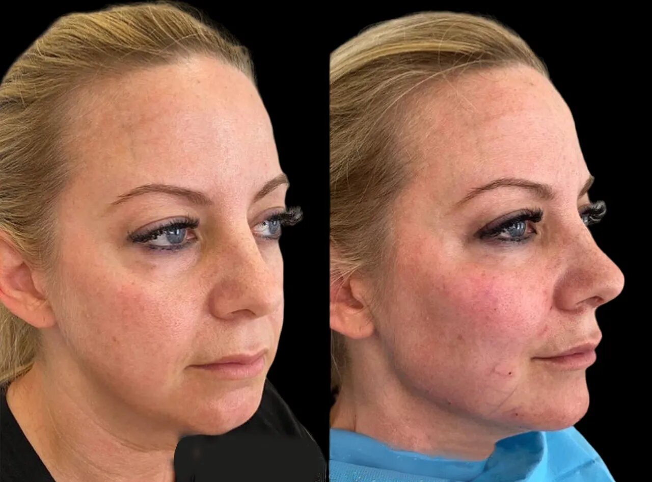 Cheek Fillers Recovery Tips from Best Doctors in Dubai