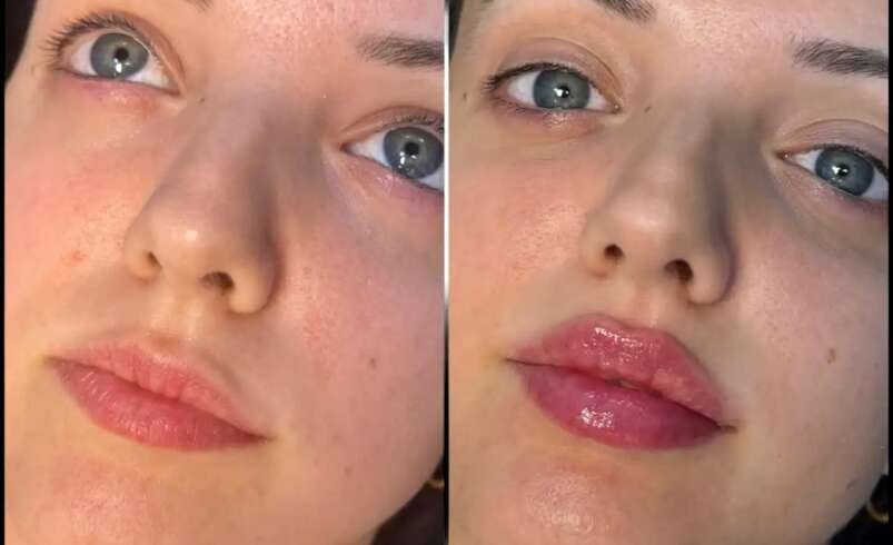 Advanced Dermal Fillers by Best Doctors in dubai