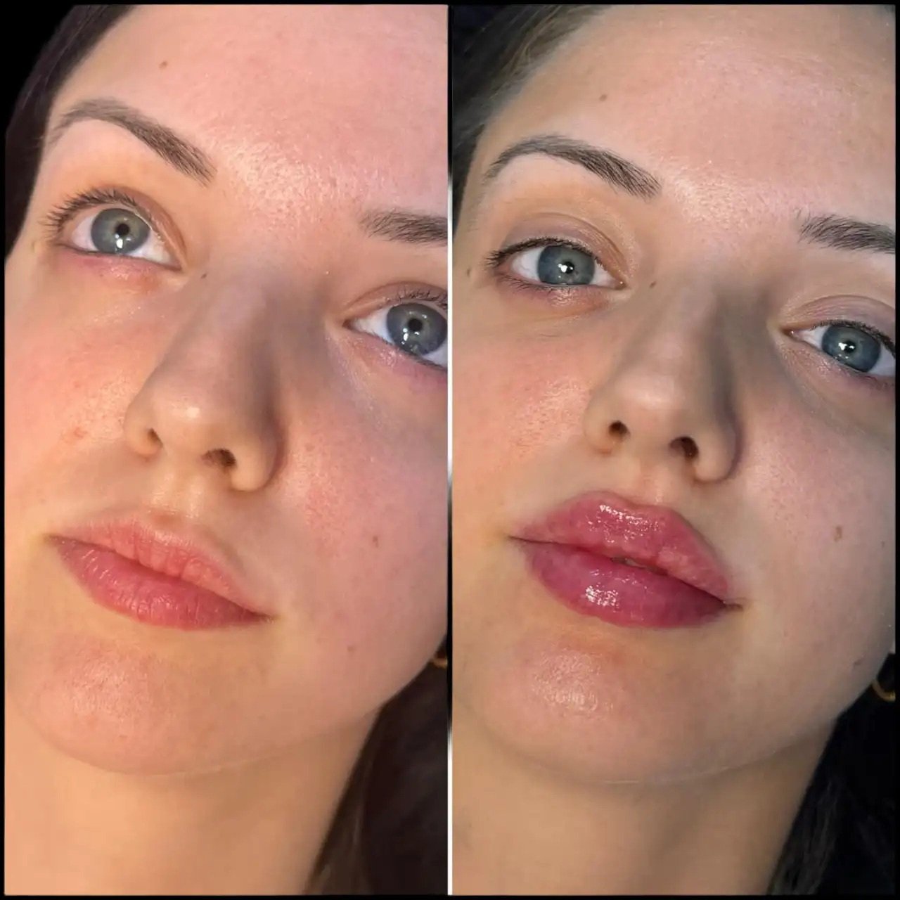 Advanced Dermal Fillers by Best Doctors in dubai