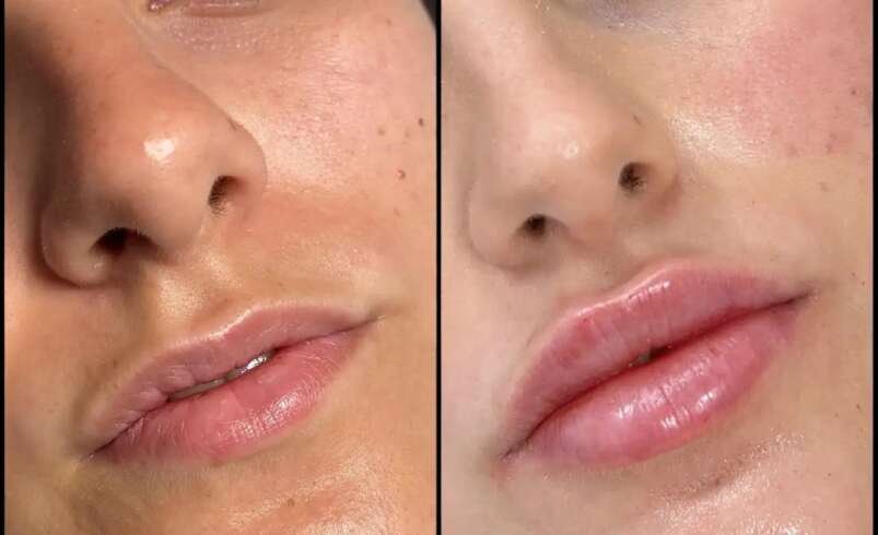 Best Doctors in Dubai for Fillers Treatment Consultation