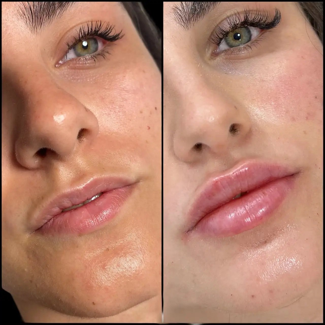Best Doctors in Dubai for Fillers Treatment Consultation