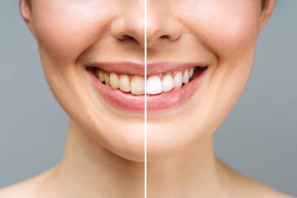 How Often Can You Get Professional Teeth Whitening in Riyadh?