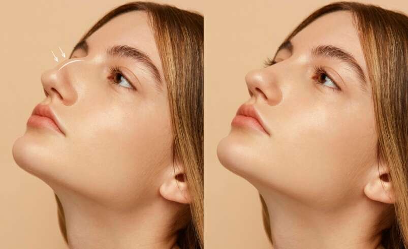 Rhinoplasty Toronto: 7 Things to Know Before Your Transformation