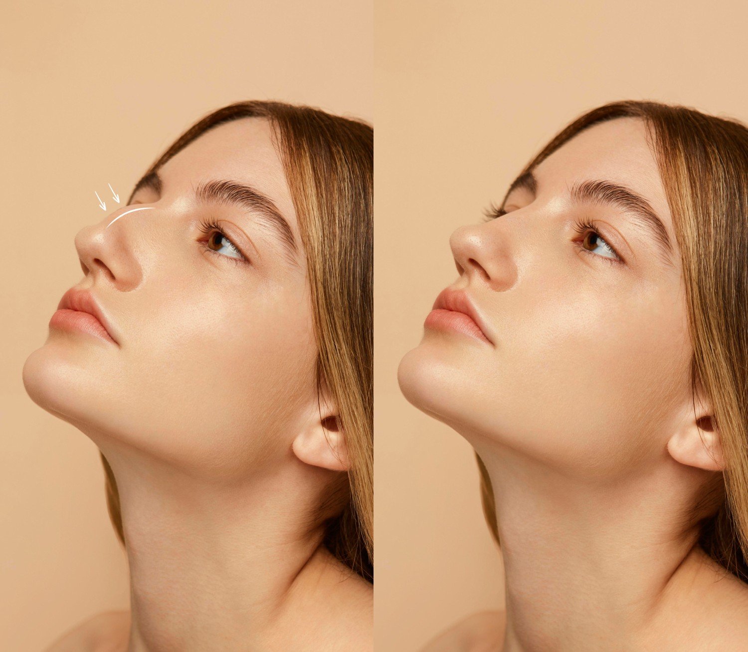 Rhinoplasty Toronto: 7 Things to Know Before Your Transformation