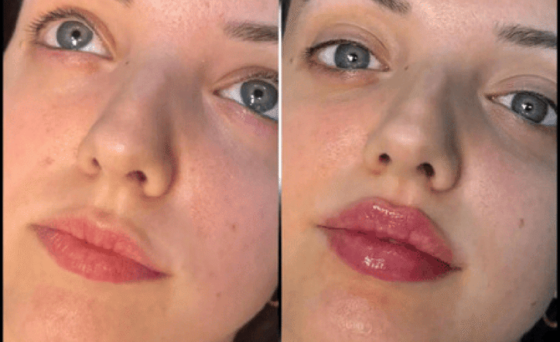 Best Aesthetic Clinic in dubai: Expert Advice on Fillers
