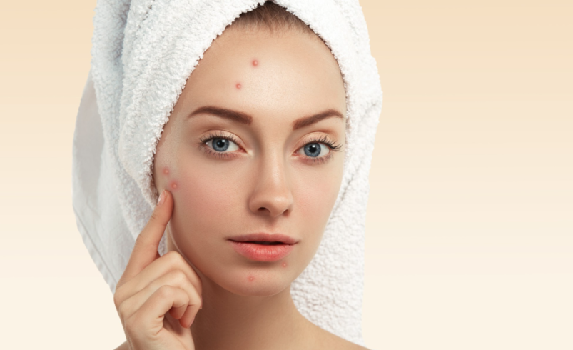 Acne Treatment In Manchester: Modern Approaches for Healthier-Looking Skin