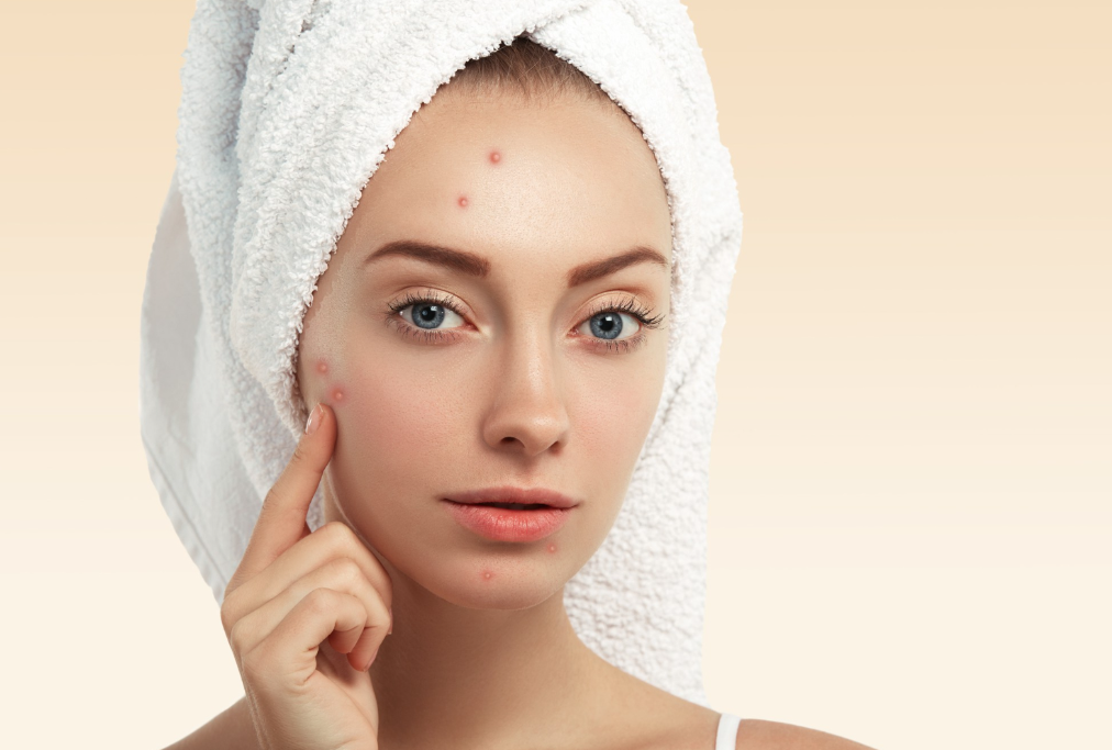 Acne Treatment In Manchester: Modern Approaches for Healthier-Looking Skin