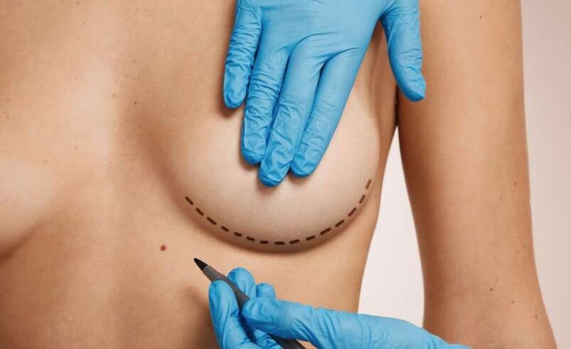 Breast Lift in Dubai: How to Minimize Scars After Mastopexy