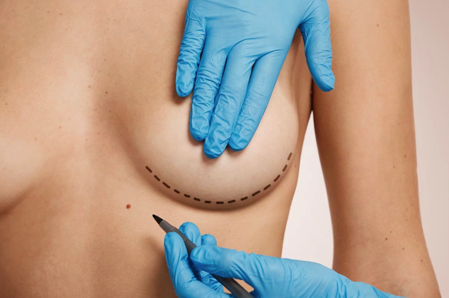 Breast Lift in Dubai: Tips for Reducing Mastopexy Scars