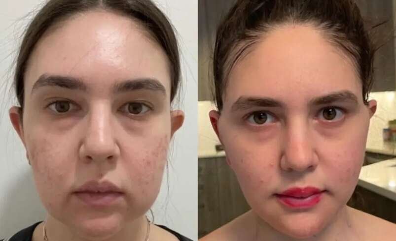 Best Buccal fat removal Surgeon in dubai Face Shape