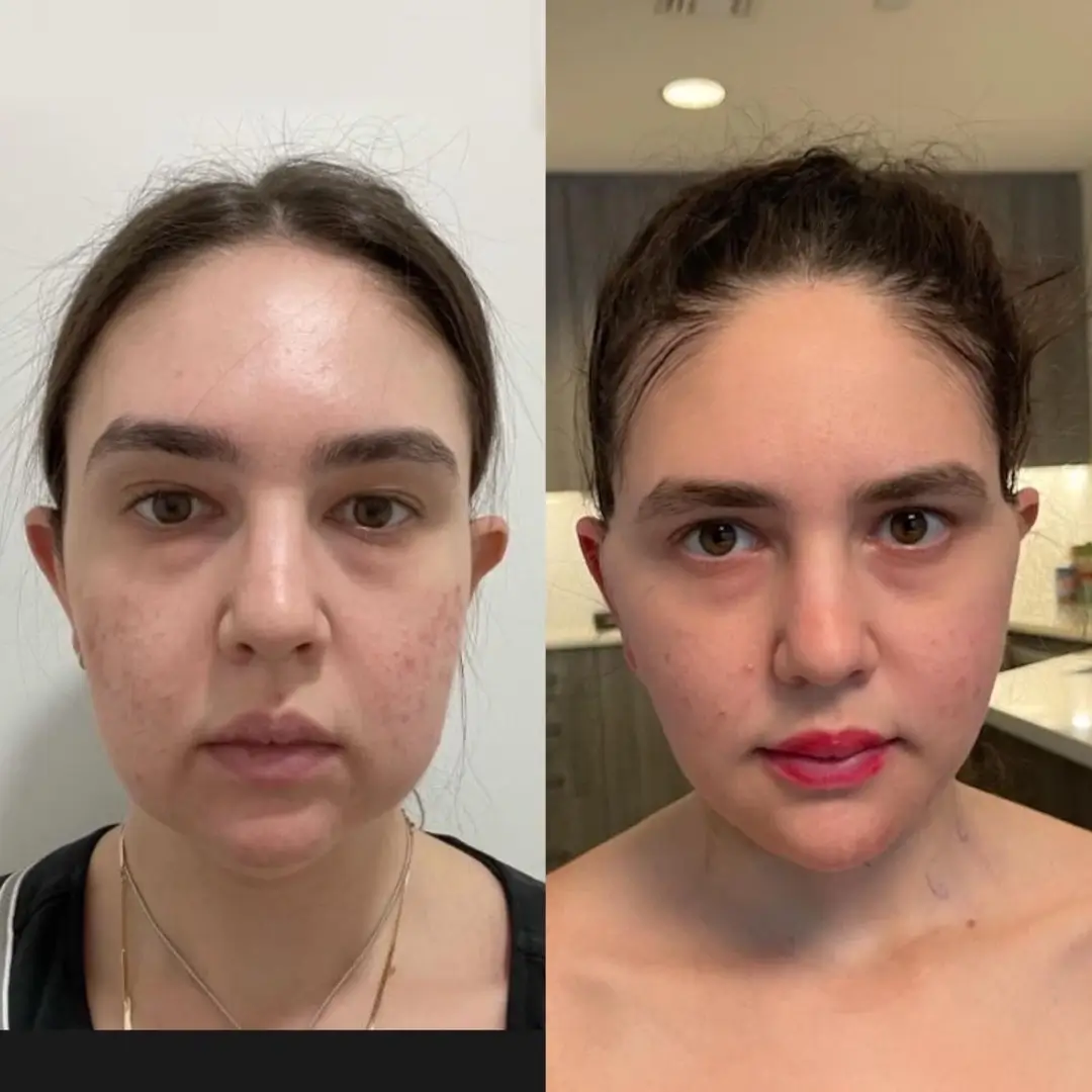 Best Buccal fat removal Surgeon in dubai Face Shape