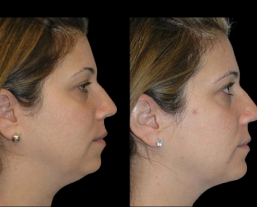 Best Double chin removal Surgeon in dubai Choice+