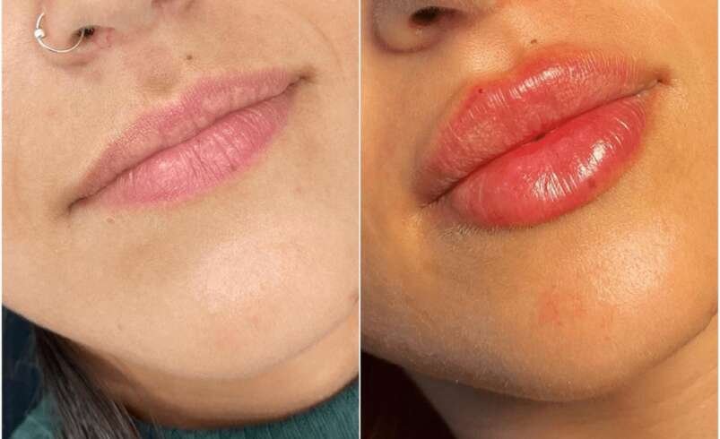 Juvederm Side Effects Best Aesthetic Clinics in Dubai