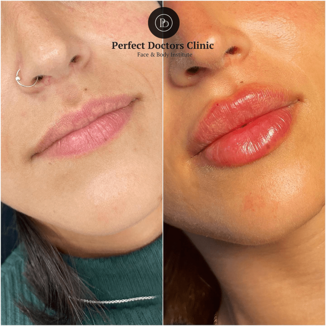 Juvederm Side Effects Best Aesthetic Clinics in Dubai
