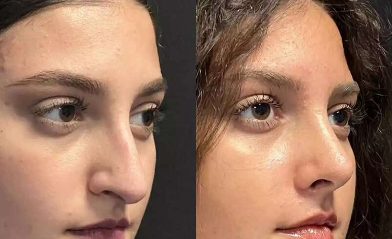 Is Nose Surgery in Dubai Worth Considering for Nasal Concerns?