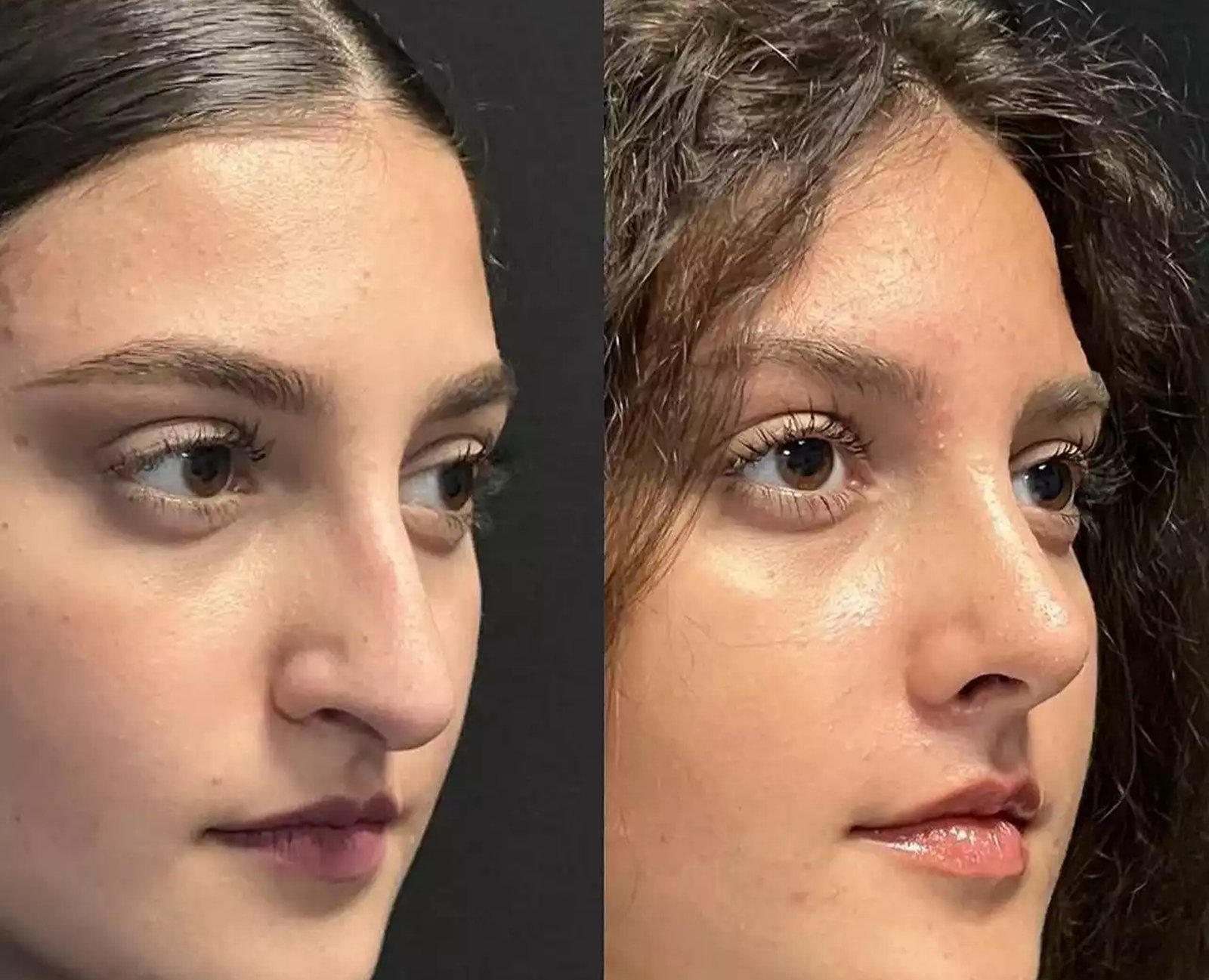 Is Nose Surgery in Dubai Worth Considering for Nasal Concerns?