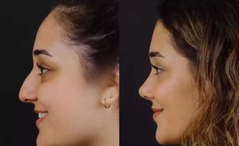 Can Nose Deviated Septum Surgery in Dubai Help Chronic Congestion?