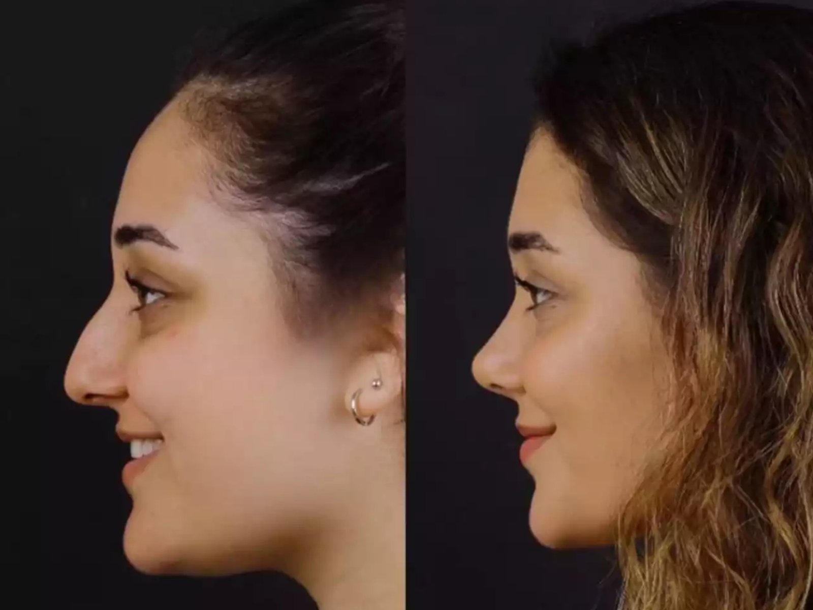 Can Nose Deviated Septum Surgery in Dubai Help Chronic Congestion?