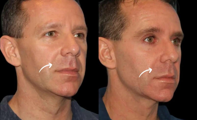 Sculptra Treatments in Dubai and Understanding Collagen Based Results