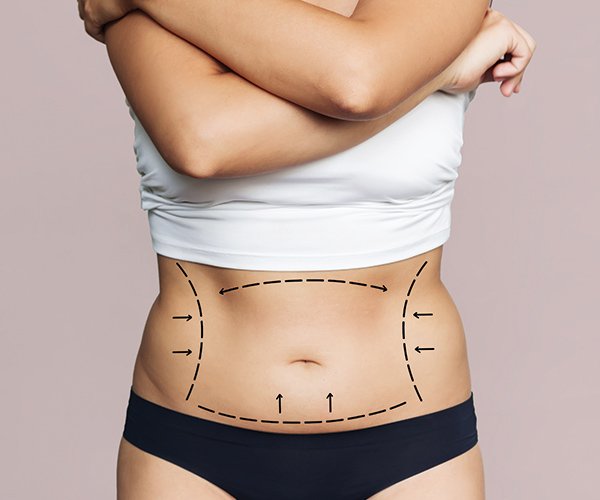Mini Tummy Tuck Dubai: How Can It Improve the Appearance of the Lower Abdomen?