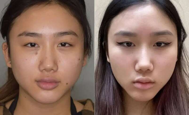 Buccal fat removal Surgery in dubai Recovery Care