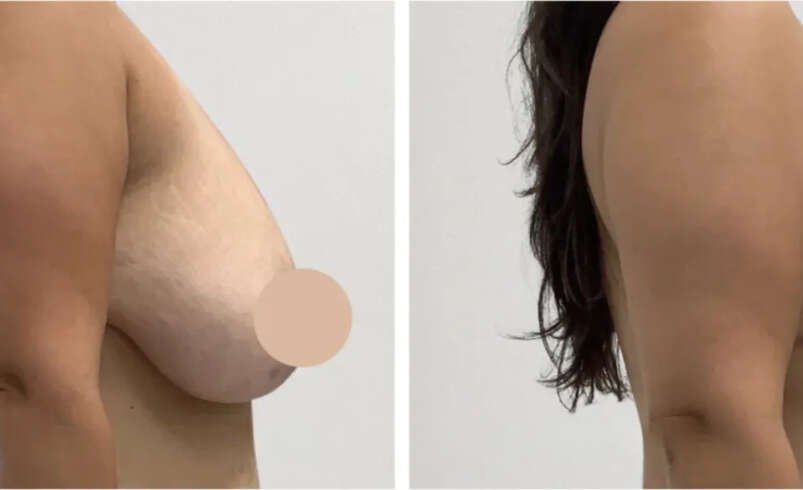 Best Breast Lift Surgeons in Dubai for Refined Breast Contouring