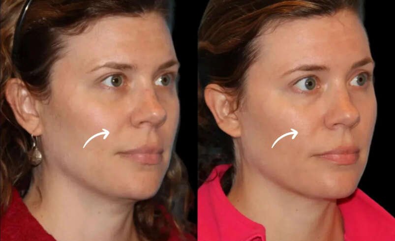 Best Plastic Surgeons in Dubai and Sculptra Fillers Treatment Priorities
